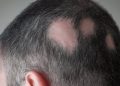 Se aprueba la primera pastilla para combatir la alopecia