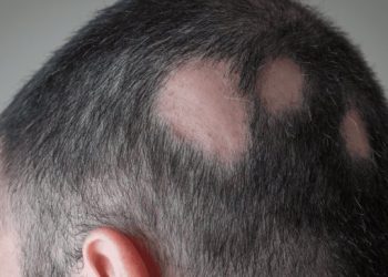 Se aprueba la primera pastilla para combatir la alopecia