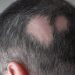 Se aprueba la primera pastilla para combatir la alopecia