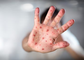 Investigadores descartan contagio de viruela del mono por transmisión aérea