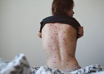 OMS: Casos de viruela del mono aumentan un 77 % en el mundo en una semana