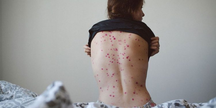 OMS: Casos de viruela del mono aumentan un 77 % en el mundo en una semana