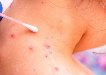 OMS: La viruela del mono puede frenarse si se toman en serio sus riesgos