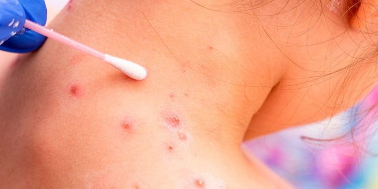 OMS: La viruela del mono puede frenarse si se toman en serio sus riesgos