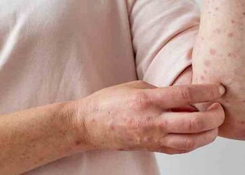 Estados Unidos: California e Illinois declaran el estado de emergencia por viruela del mono