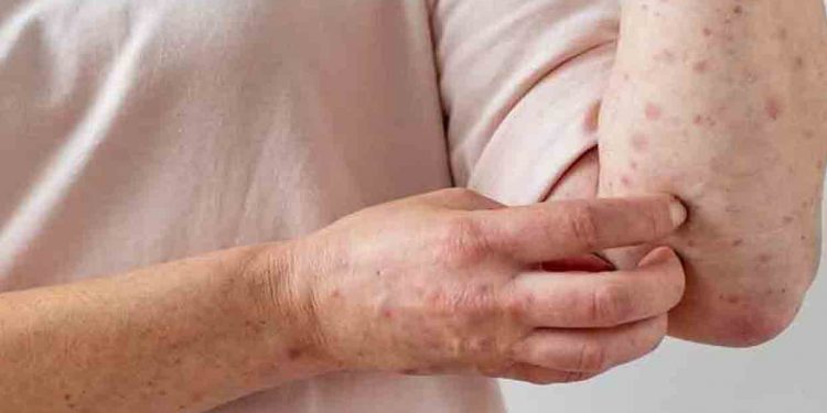 Estados Unidos: California e Illinois declaran el estado de emergencia por viruela del mono