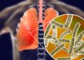 Bacteria legionella causa brote de neumonía con 4 muertos en Argentina