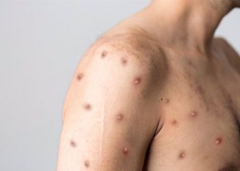 Viruela del mono en Colombia: Autoridades confirman más de 1.200 casos