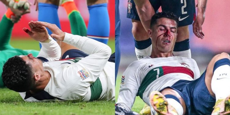 Ronaldo termina ensangrentado tras sufrir un duro golpe en la nariz durante un partido